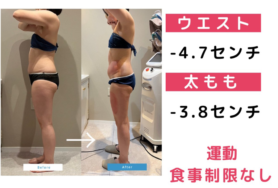 高知で初の脂肪冷却によるダイエット痩身ならエステ